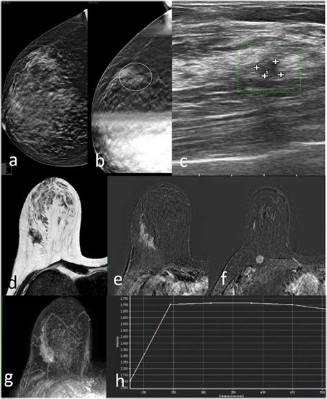 spot compression test|what is spot compression tomosynthesis.